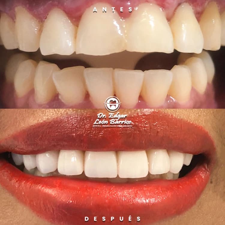 Transformación dental 10