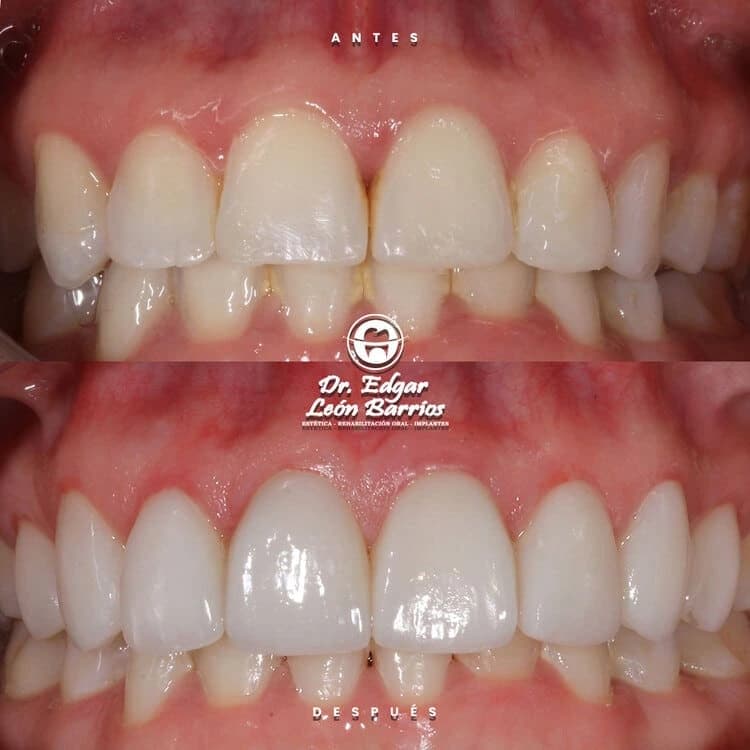 Transformación dental 2