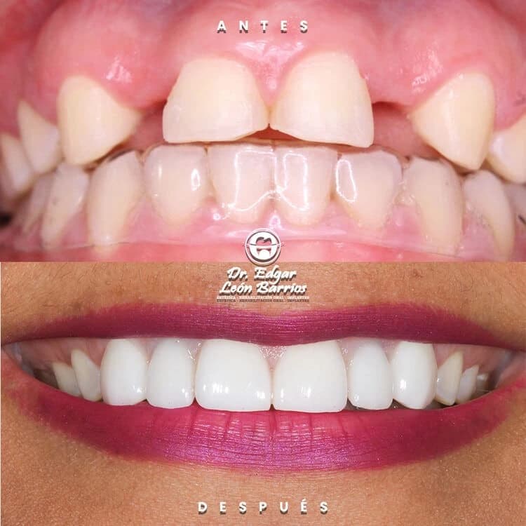 Transformación dental 8